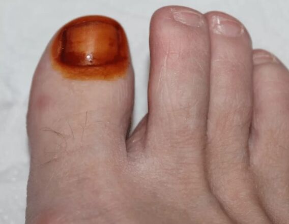 Treatment of the iodine mushroom