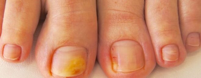 Nail fungus