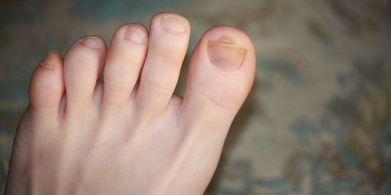 toenail fungus
