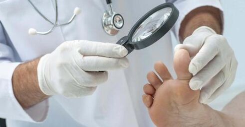 treatment of foot fungus by a doctor