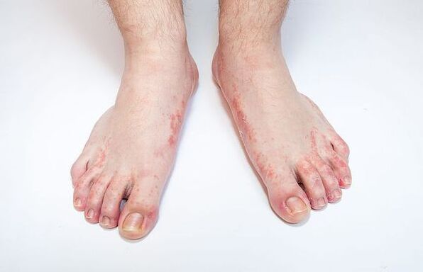 Fungal skin disease of the feet
