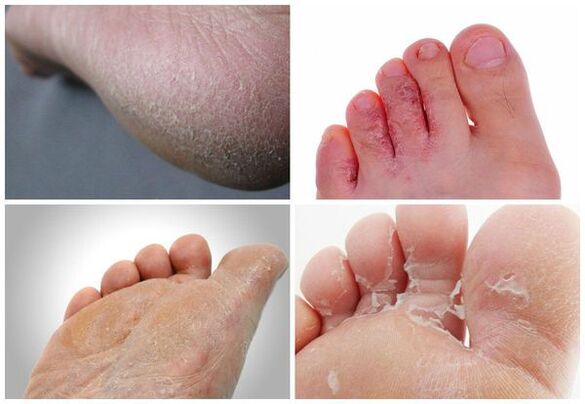 The main manifestations of mycosis of the feet are keratinization of the skin, cracking, desquamation