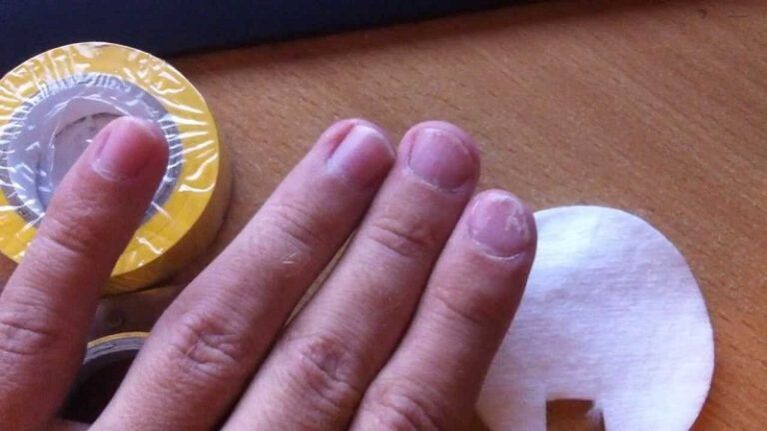 Nail fungus and their treatment with folk remedies