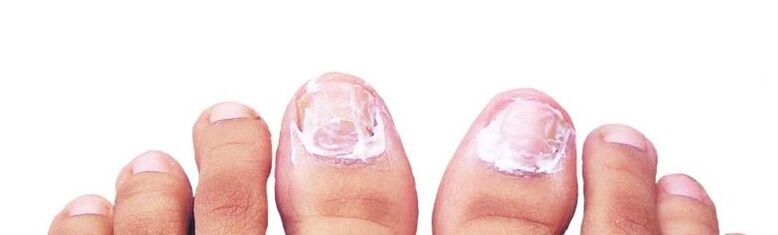 nail ointment against fungi