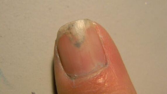 symptoms of nail fungus