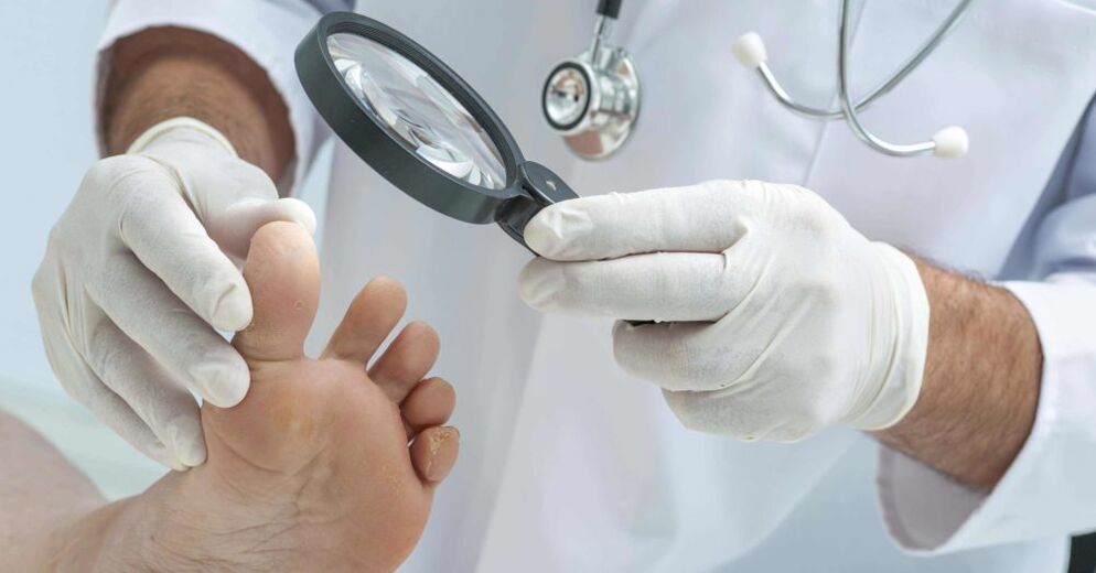 the doctor examines the feet for fungi